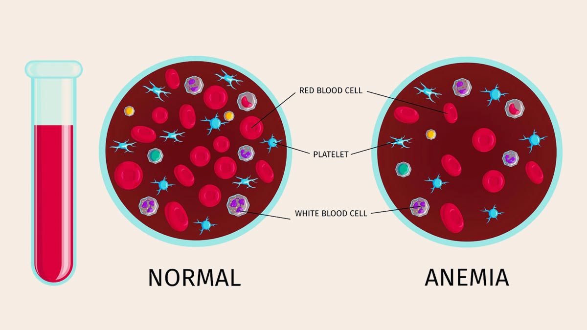 World Kidney Cancer Day: 5 Symptoms Of Kidney Cancer You Should Be ...