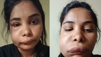 रूट कैनाल गलत होने से बिगड़ा एक्ट्रेस स्वाति सतीश का चेहरा, जानें इस सर्जरी में कौन सी सावधानियां हैं जरूरी