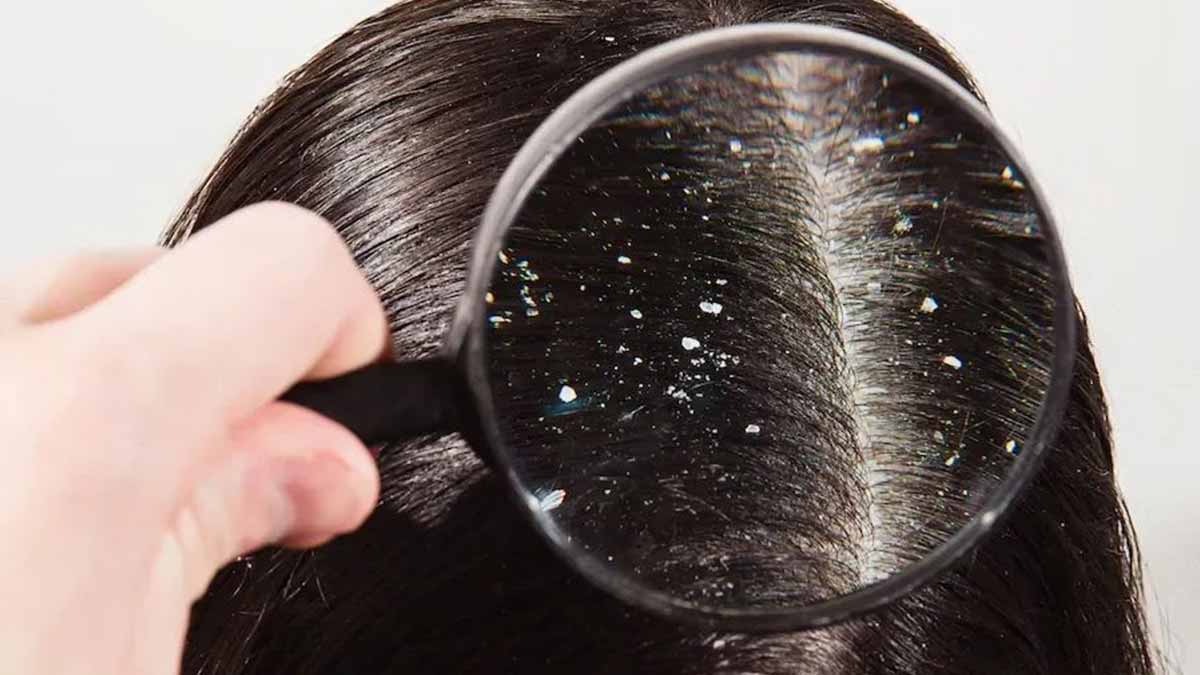dandruff