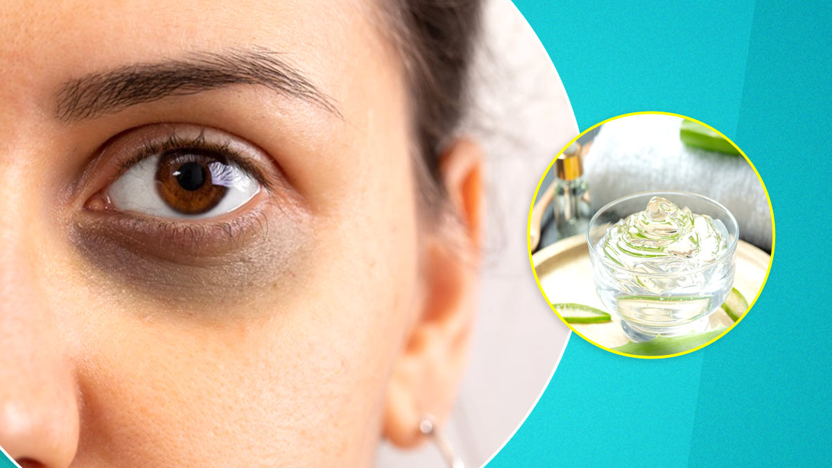 Dark circles will disappear in a pinch, use these Home Remedies