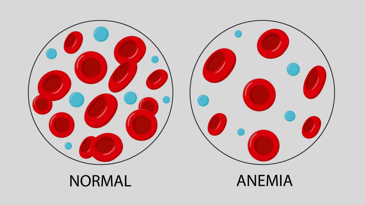 what-is-sickle-cell-disease-onlymyhealth