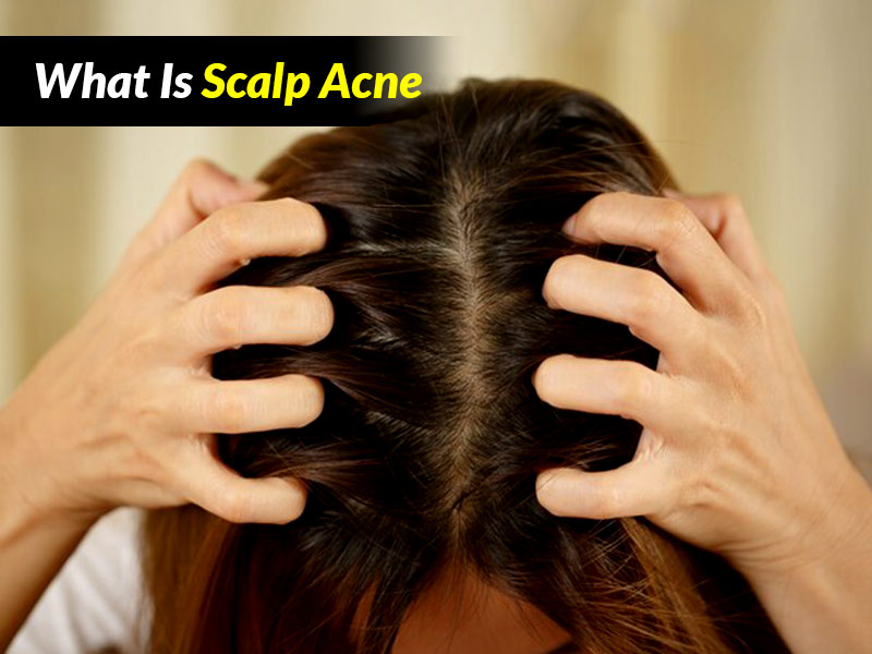 Scalp Acne Treatment, Symptoms and Prevention Tips