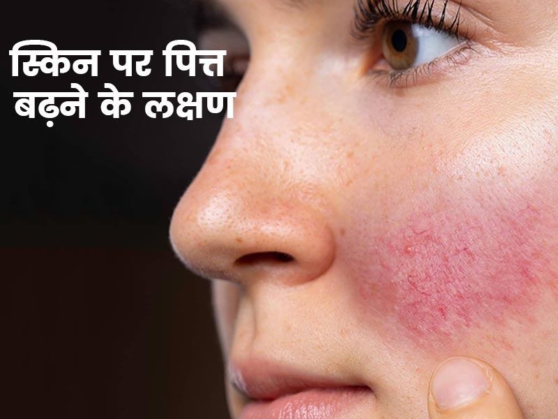 पित्त बढ़ने से स्किन पर दिखते हैं ये 5 लक्षण, आयुर्वेद एक्सपर्ट से जानें कैसे संतुलित करें पित्त