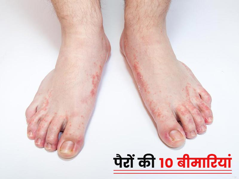 पैरों से जुड़ी इन 10 बीमारियों को न करें नजरअंदाज, बन सकती हैं परेशानी का कारण