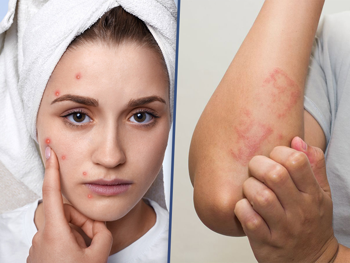 Dermatomyositis disease: क्या है डर्मेटोमायोसाइटिस बीमारी, जिसने ली 'दंगल गर्ल' सुहानी भटनागर की जान