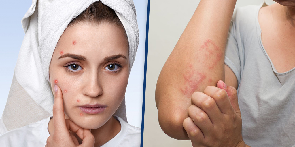 एटॉपिक डर्मेटाइटिस के लक्षण, कारण और इलाज Atopic Dermatitis in Hindi