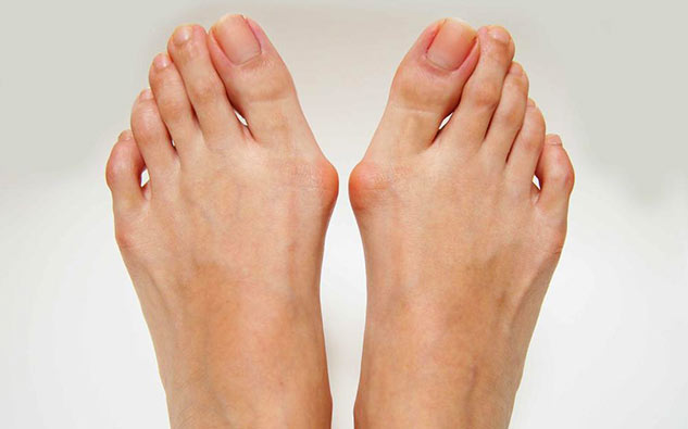 inside_bunions