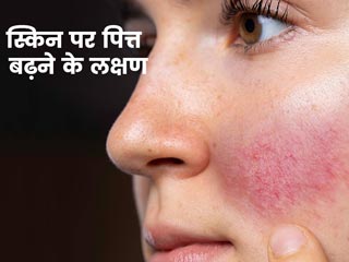 पित्त बढ़ने से स्किन पर दिखते हैं ये 5 लक्षण, आयुर्वेद एक्सपर्ट से जानें कैसे संतुलित करें पित्त