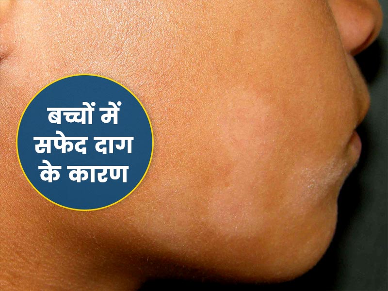 बच्चों के चेहरे पर सफेद दाग के क्या कारण हो सकते हैं? डॉक्टर से जानें बचाव के उपाय