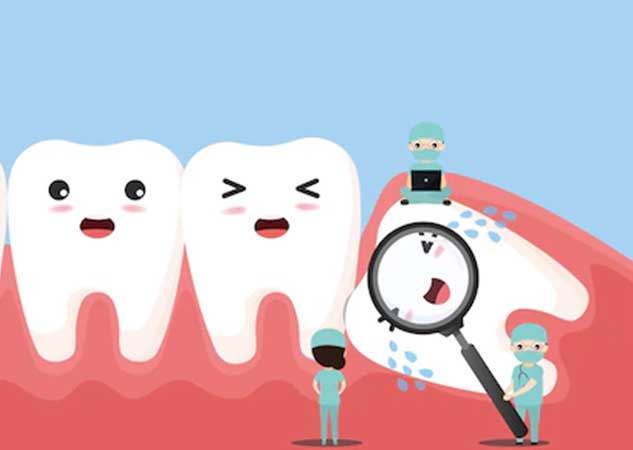 Impacted Wisdom Teeth: What are they? Should you get them removed ...