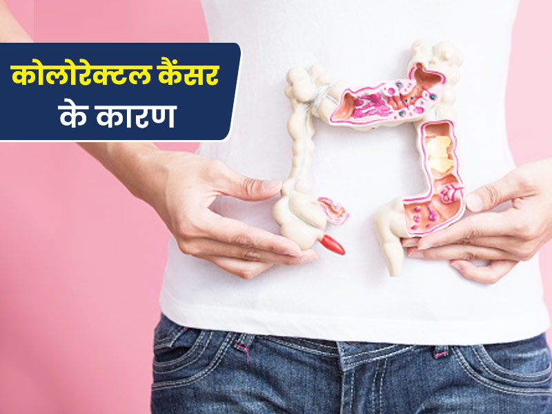 कोलोरेक्टल कैंसर के लिए ये 6 कारण हो सकते हैं जिम्मेदार, समय रहते पहचानें लक्षण और बरतें सावधानी