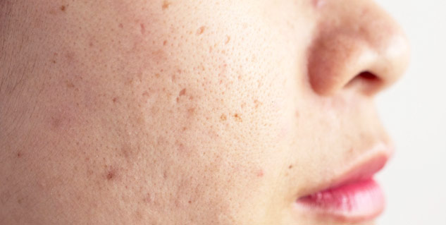 acne-prone-meaning-in-hindi-carolyn-knox