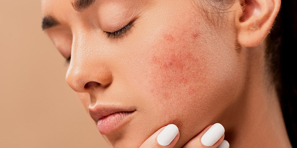 Acne Prone Skin Meaning In Hindi Makeup Tips 