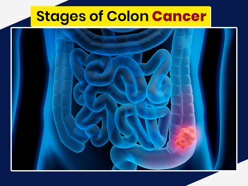 Colon Cancer| Stages And Effects