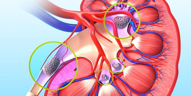 kidney stone treatment in hindi