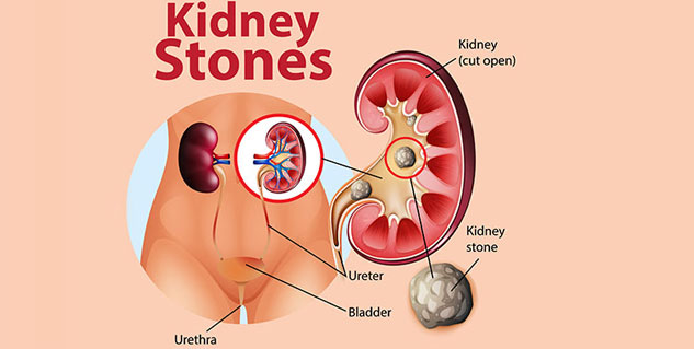 kidney stone in hindi