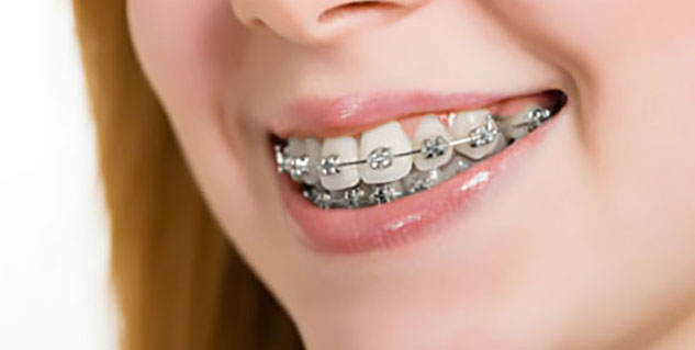 Teeth-Alignment-Treatment