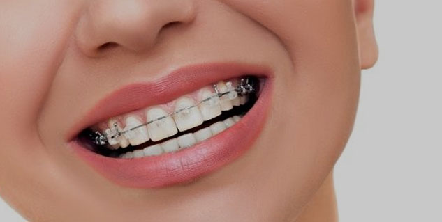 Teeth-Alignment-Treatment