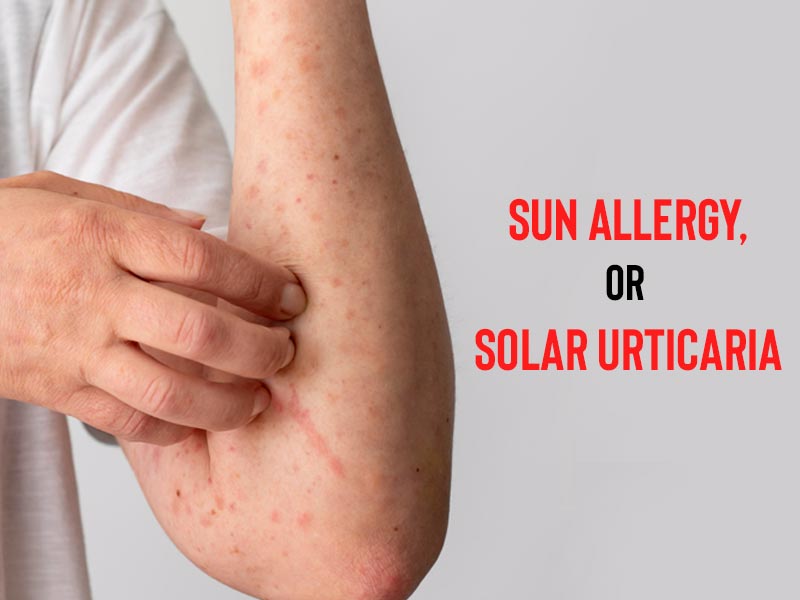 Sun Allergy, Or Solar Urticaria: What It Is, Signs, Treatment ...