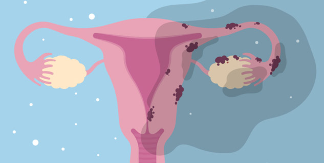 Women's Health: Endometriosis & Ovarian Cancer Genetically Linked, Says ...