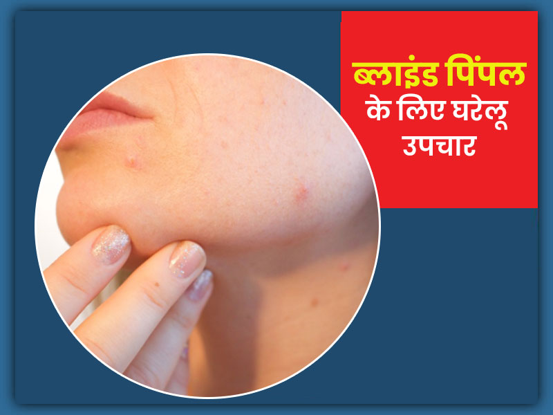 ब्लाइंड पिंपल्स (स्किन के नीचे पिंपल) क्यों होते हैं? जानें छुटकारा पाने के 7 उपाय
