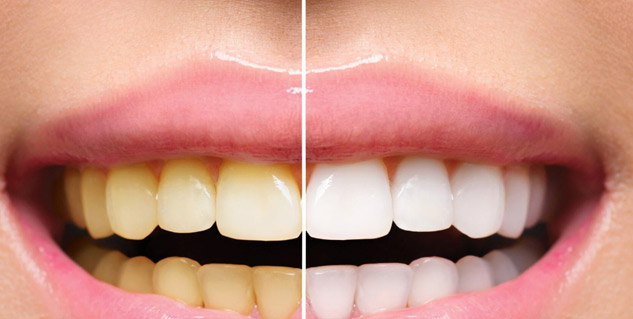 Radish-For-Tooth-Discoloration