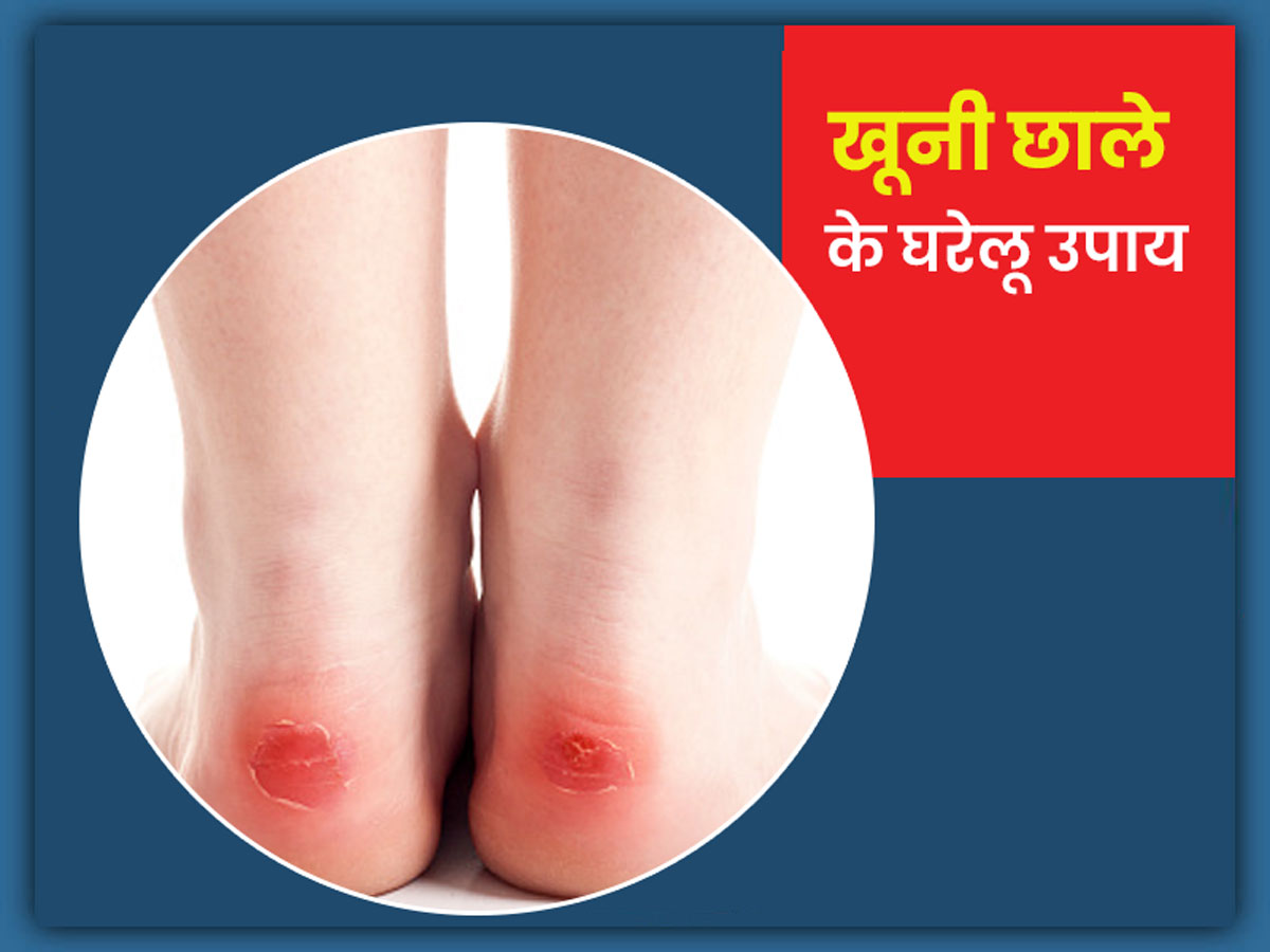 हाथ-पैरों में बन जाएं खूनी छाले तो अपनाएं ये 5 घरेलू नुस्खे, मिल सकता है आराम