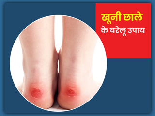 हाथ-पैरों में बन जाएं खूनी छाले तो अपनाएं ये 5 घरेलू नुस्खे, मिल सकता है आराम