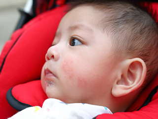 लार बहने के कारण बच्चे के मुंह के आसपास हो गए रैशेज (drool rashes)? जानें इससे बचाव के उपाय