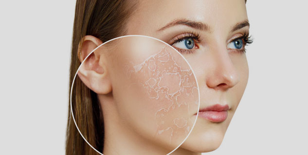 dry skin