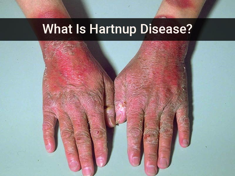 Hartnup Disease: Know Symptoms And Causes Of This Rare Condition