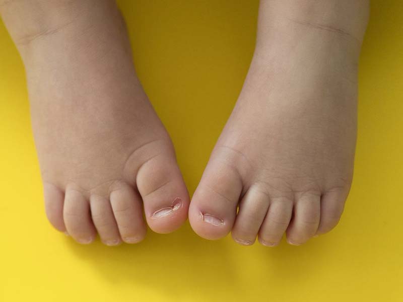बच्चों में पैर के नाखून अंदर की तरफ बढ़ने (इन्ग्रोन टो नेल्स) की समस्या को कैसे ठीक करें?
