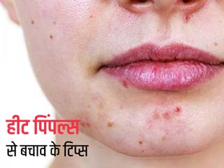 गर्मियों में हीट पिंपल्स (धूप के कारण खुजली वाले दाने) से बचाव के लिए एक्सपर्ट से जानें 5 टिप्स