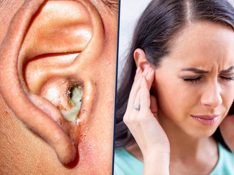कान पकने की समस्या क्यों होती है? जानें इसके कारण, लक्षण और घरेलू उपचार