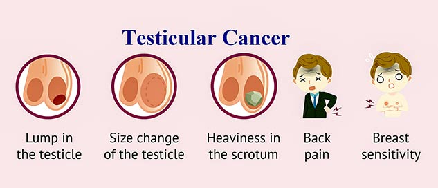 टेस्टिकुलर (अंडकोष) कैंसर का पता लगाने के लिए कौन सी जांच की जाती है 