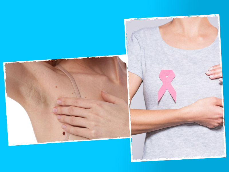 Breast Cancer Moles and Spots