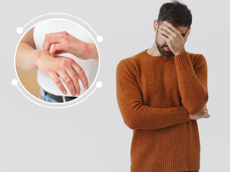 Psoriasis and Male Fertility: What Is The Link, Risks and Complications