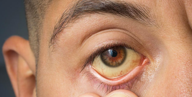 What Causes Yellow Eyes or Jaundice Eyes? Know All About This Eye ...