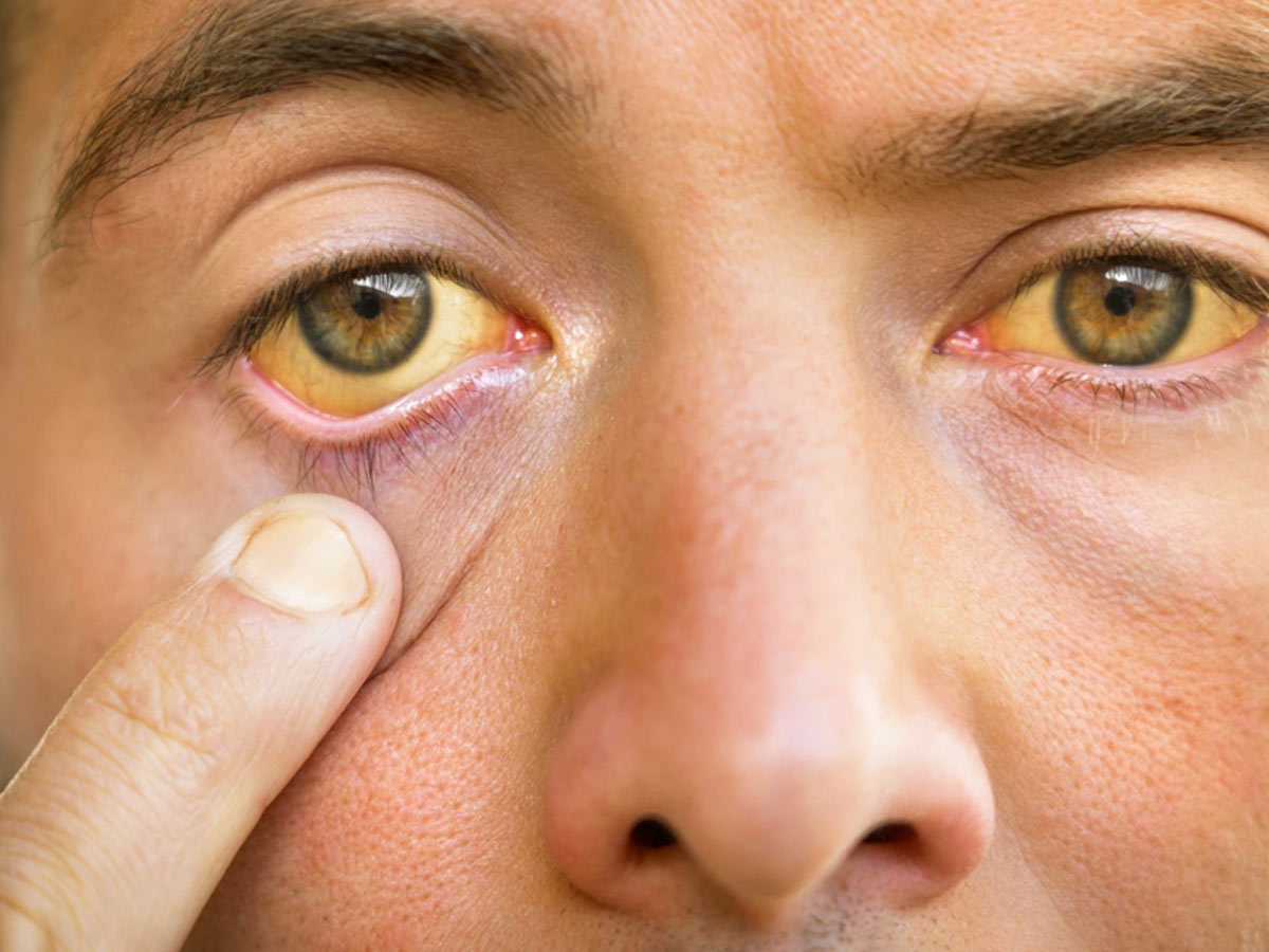 ما المرض الذي يسبب الحكة المستمرة واصفرار الجلد والعينين؟