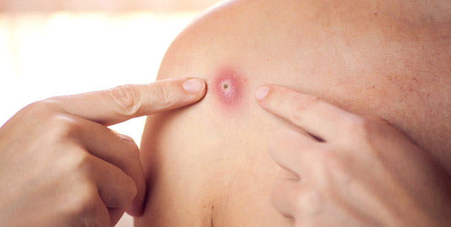 Monkeypox-Virus--in-Hindi