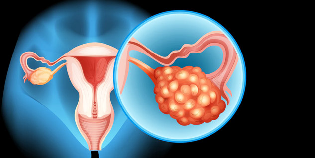 Ovarian-Cancer-in-Hindi