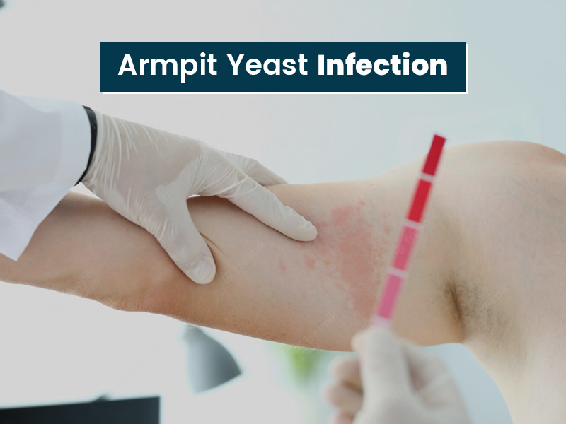 Can Yeast Infection Occur On Armpits? Symptoms, Causes And Prevention Tips  You Should Know