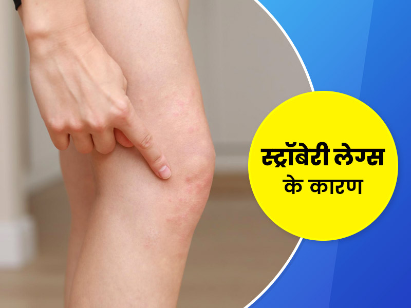 पैरों के काले चित्तीदार धब्बों (स्ट्रॉबेरी लेग्स) को कम करने के लिए अपनाएं ये 6 घरेलू उपचार