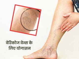 वेरीकोज वेन्स की समस्या है तो करें ये 3 योगासन, मिलेगा फायदा
