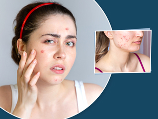 Endometriosis Acne Treatment: एंडोमेट्रियोसिस एक्ने क्या है? इन उपायों से पाएं राहत