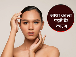 माथे की त्वचा काली पड़ने के पीछे हो सकते हैं ये 5 कारण, जानें कालेपन को कम करने के उपाय