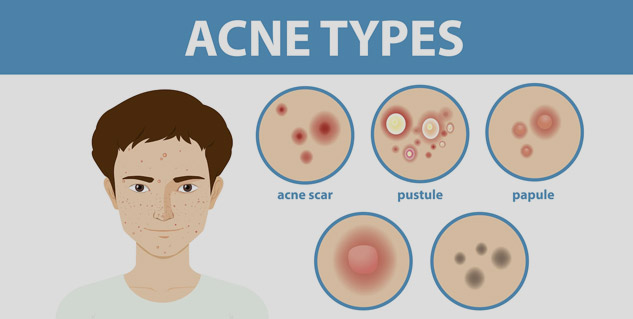 types of acne