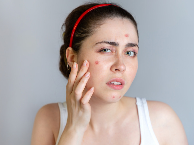 Types of Acne On Face| Acne Treatment - What Are The 7 Types Of Acne and  How To Treat Them