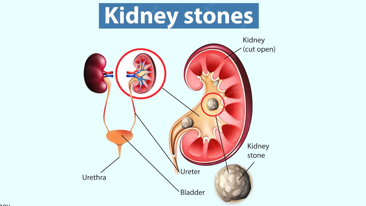 kidney stone 
