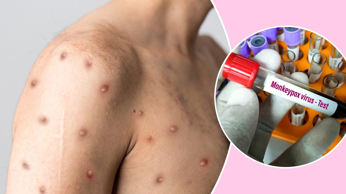 What Is Monkeypox: Symptoms, Pictures, and Treatment